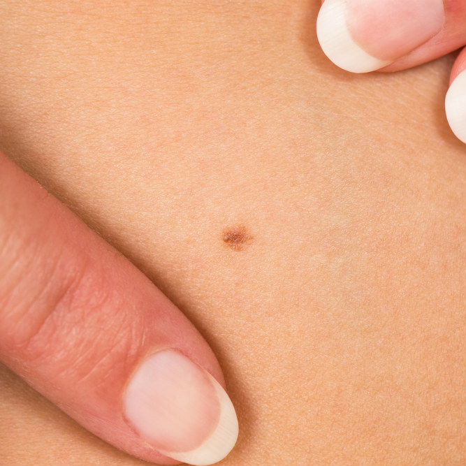 גידולים בעור