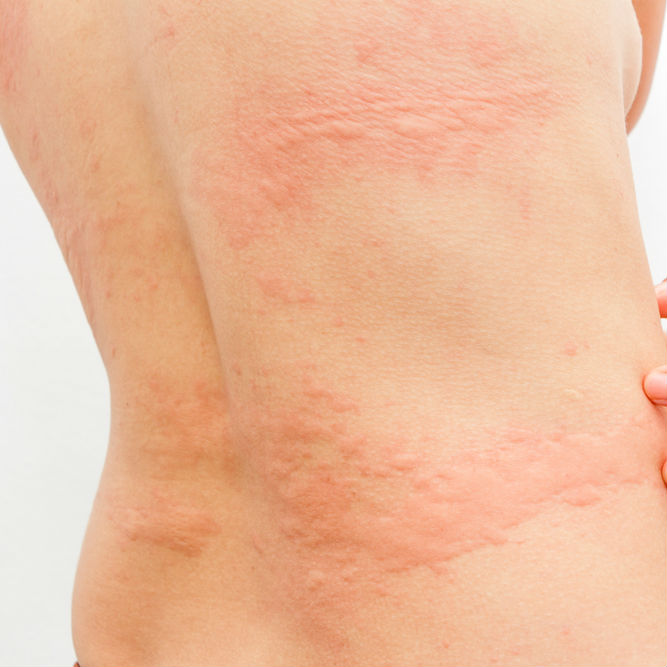 ניתן לזהות את המחלה ע"י נגעים היוצרים גירוד ותחושה לא נעימה