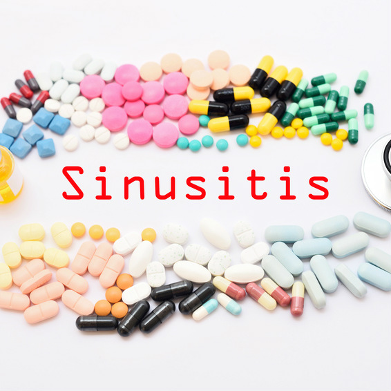 סינוסיטיס