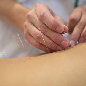 דיקור יפני וסיני