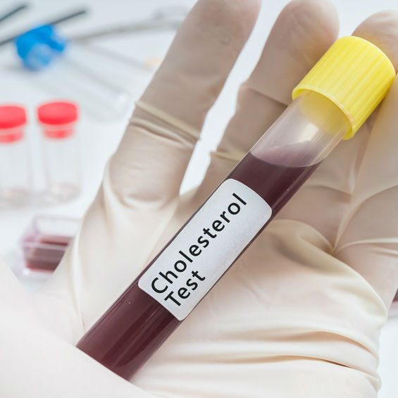 בדיקת כולסטרול