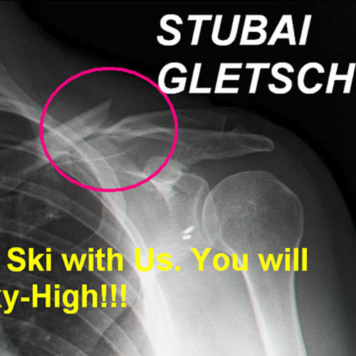 שבר בעצם הבריח