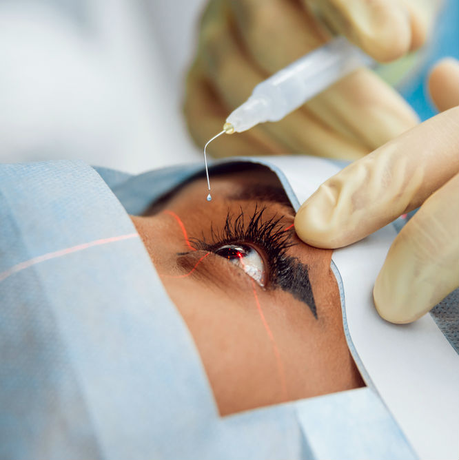 תהליך ניתוח קטרקט