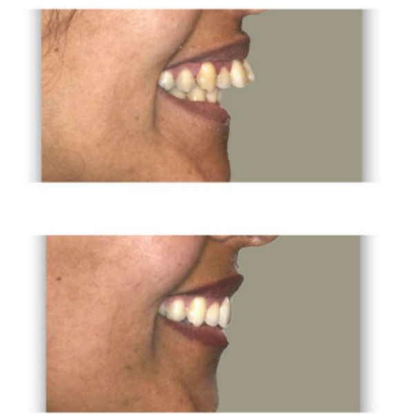 לפני ואחרי טיפול להכנסת שיניים בולטות