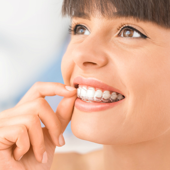 יישור שיניים באמצעות סדים שקופים