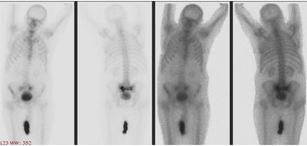 מיקומה של עצם העצה (סקרום)