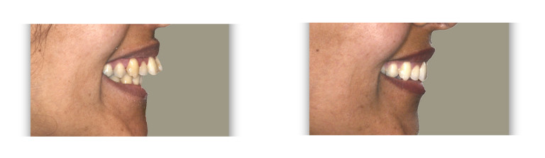 לפני ואחרי טיפול להכנסת שיניים בולטות